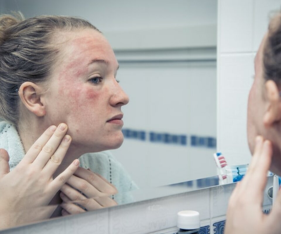 Was ist Rosacea? Rosacea Info